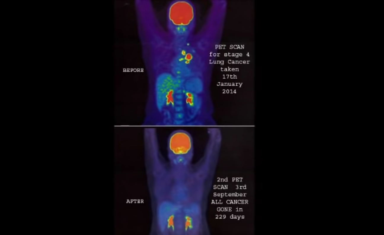 Sharon Kelly Cannabis Killed My Terminal Stage IV Lung